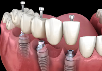 Dental implant price: What is the difference between grade 4 titanium, grade 5 titanium, and titanium alloy? Dental implant price: What is the difference between grade 4 titanium, grade 5 titanium, and titanium alloy?